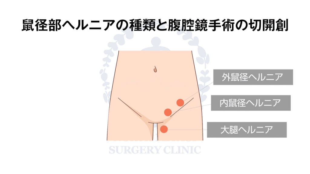 北みやぎ外科クリニック様 手術前説明動画2